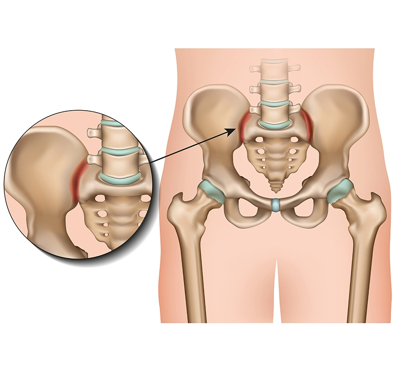 Bolečina v sakroiliakalnem sklepu (disfunkcija sakroiliakalnega sklepa)
