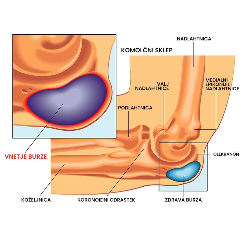 Bursitis komolca