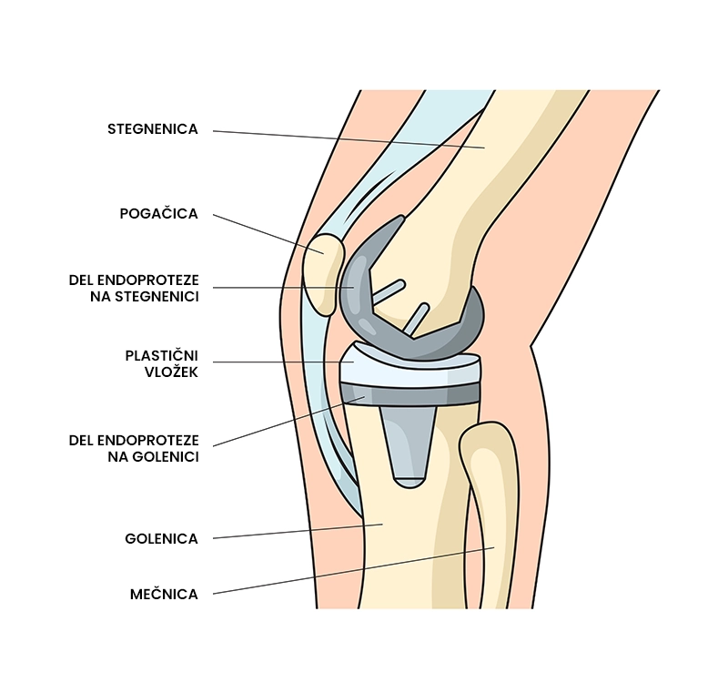 Endoproteza kolena