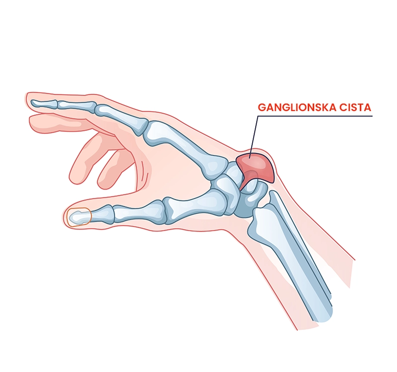 Ganglionska cista zapestja