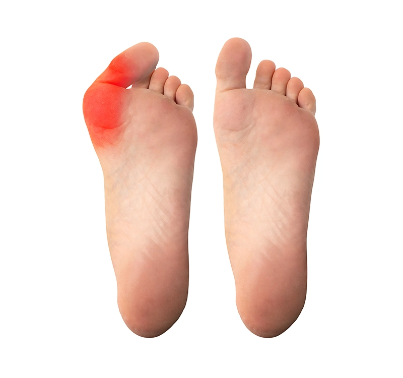 Hallux valgus