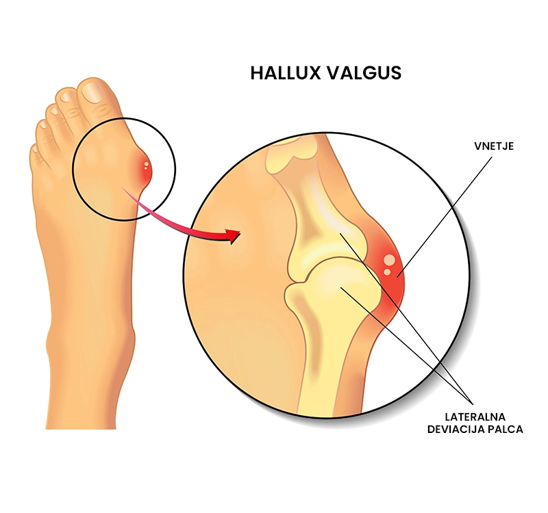 Hallux valgus