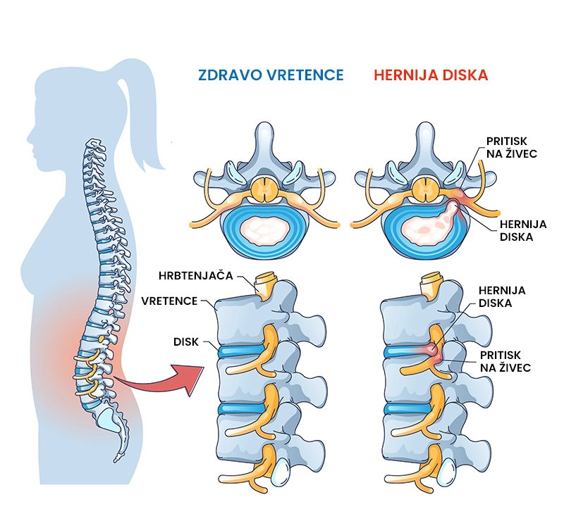 Hernija diska (diskus hernija ledvene hrbtenice)