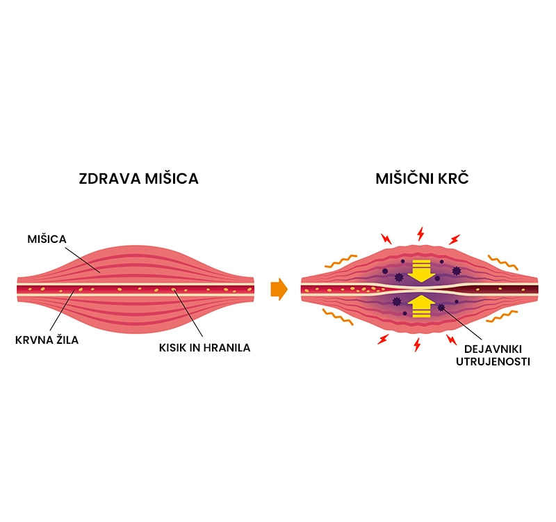 Mišični krč