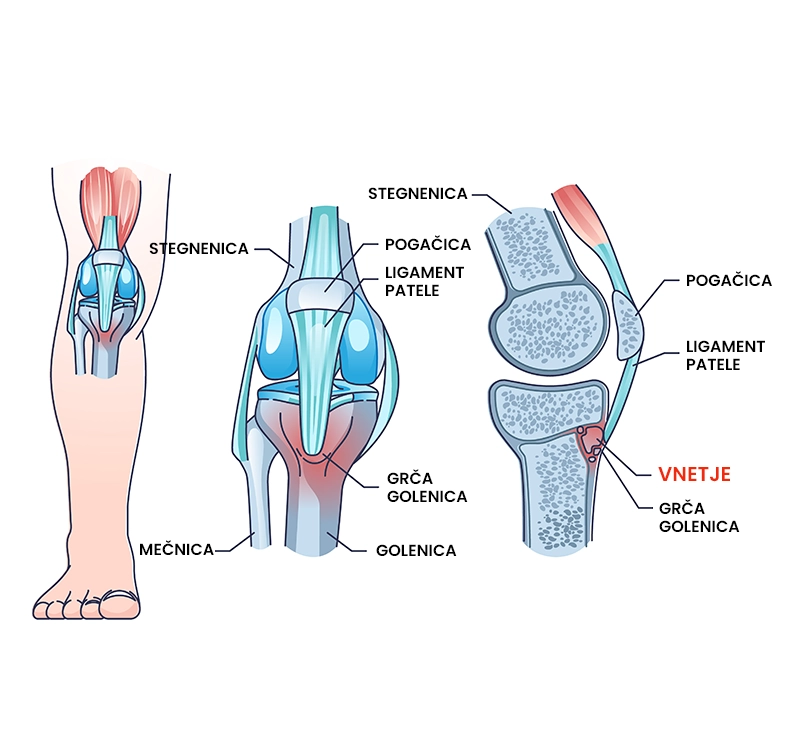 Osgood-Schlatter sindrom (osteohondroza)