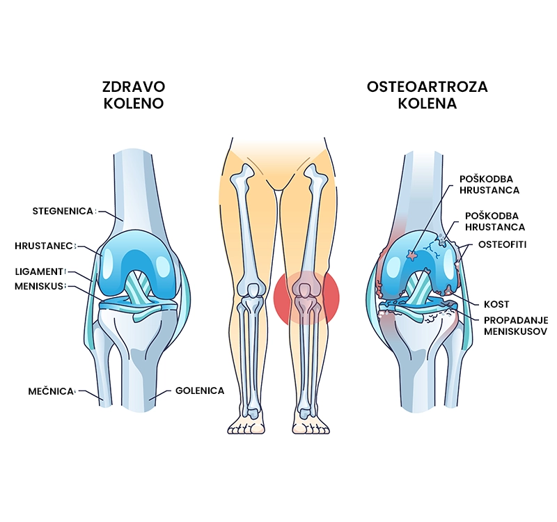 Osteoartroza kolena