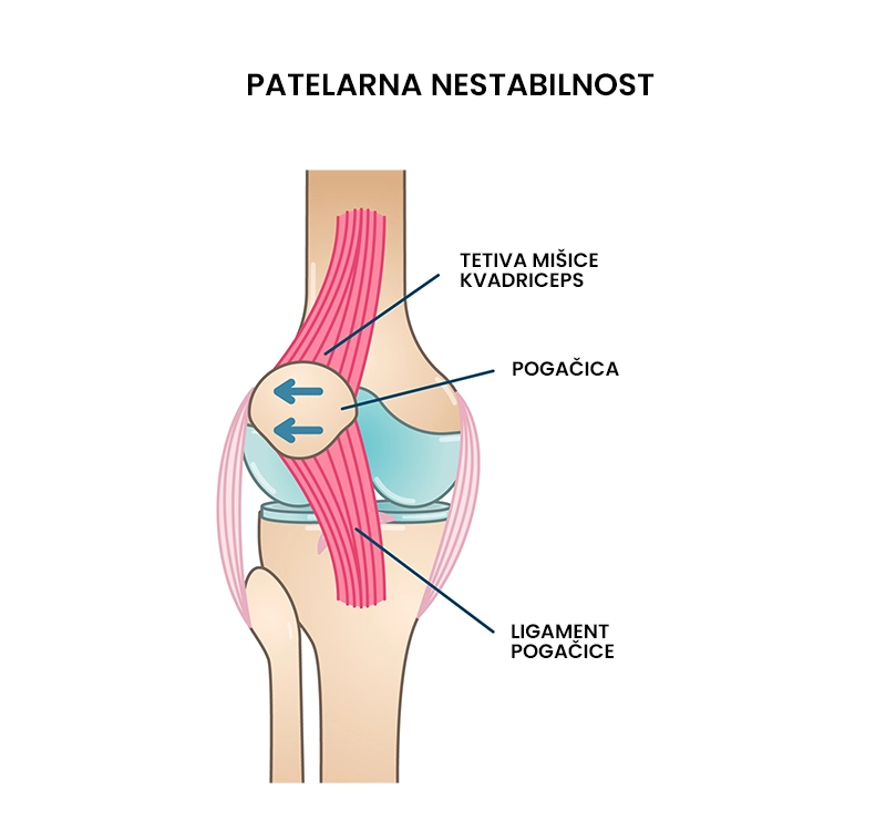 Patelofemoralna nestabilnost