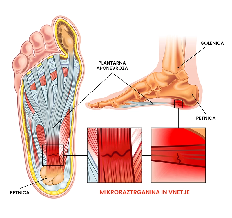 Plantarni fasciitis