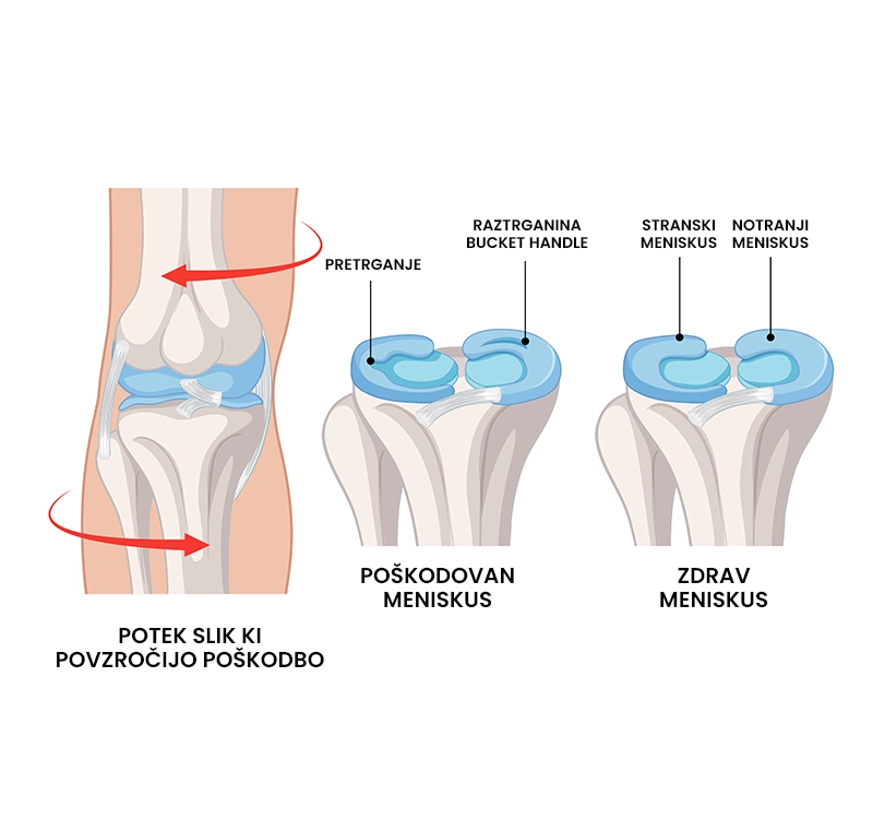Poškodba meniskusa