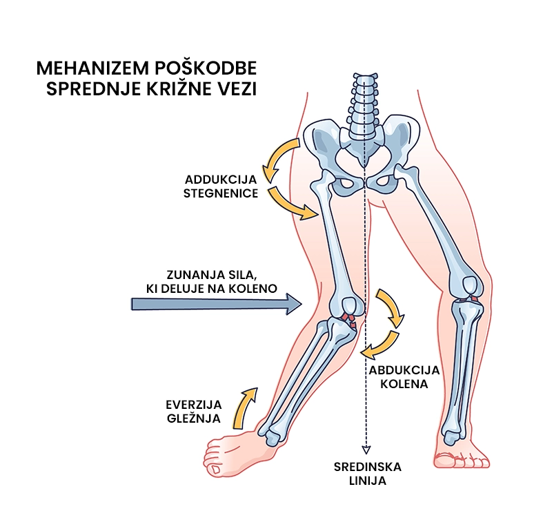 Poškodba sprednje križne vezi (polna ali delna ruptura križne vezi)