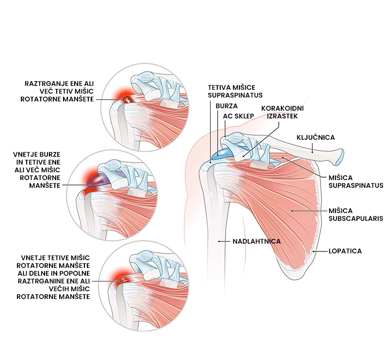 Poškodba rotatorne manšete