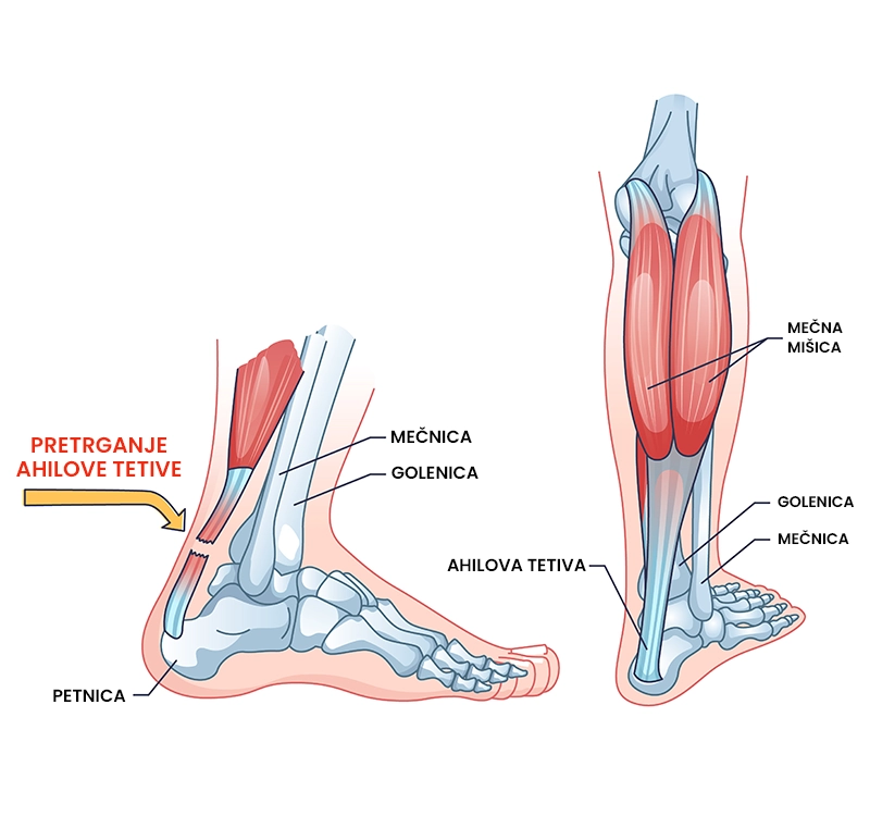 Ruptura ahilove tetive