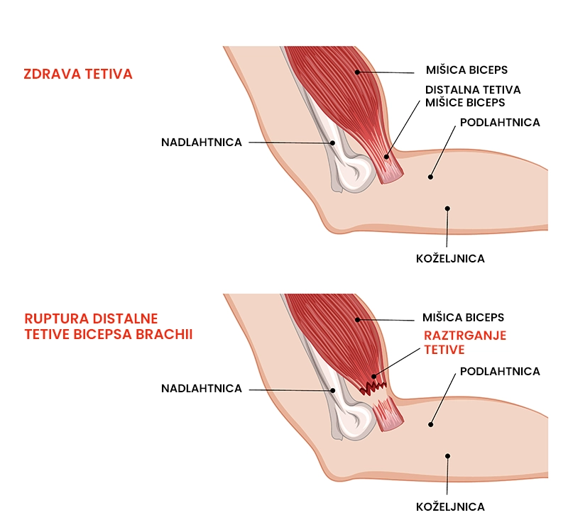 Ruptura distalne tetive bicepsa brachii