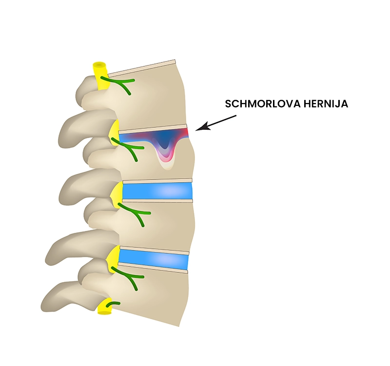 Schmorlova hernija (intervertebralna hernija)