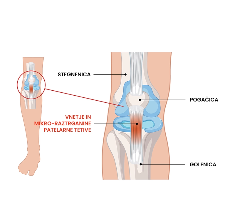 Skakalno koleno (patelarna tendinopatija)