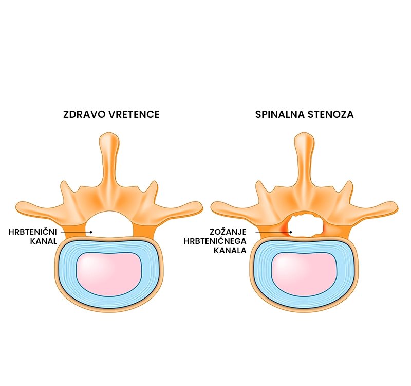 Spinalna Stenoza