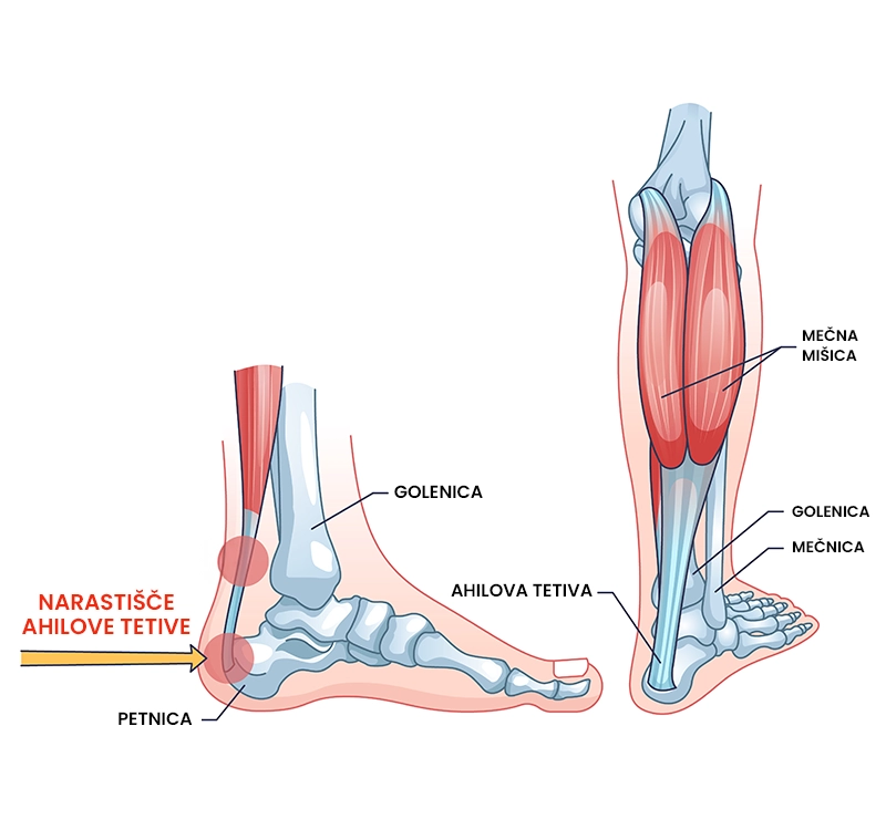 Tendinopatija ahilove tetive