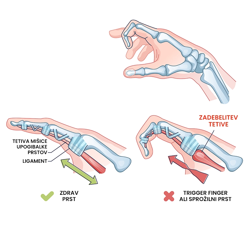 Trigger finger (sprožilni prst)