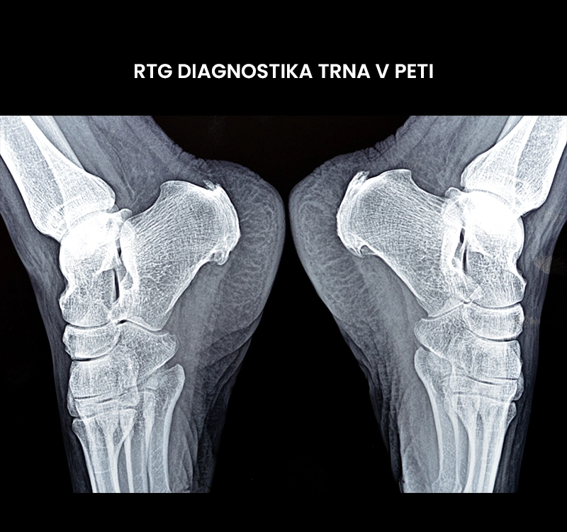 RTG diagnostika trna v peti