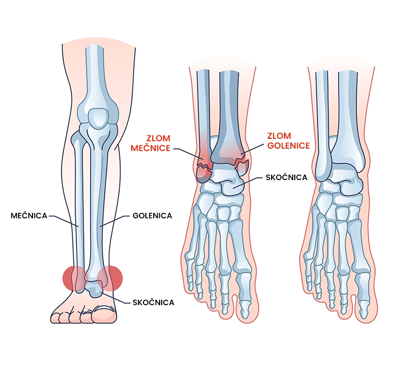 Zlom gležnja