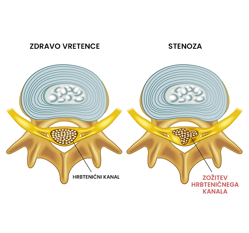 Cervikalna spinalna stenoza