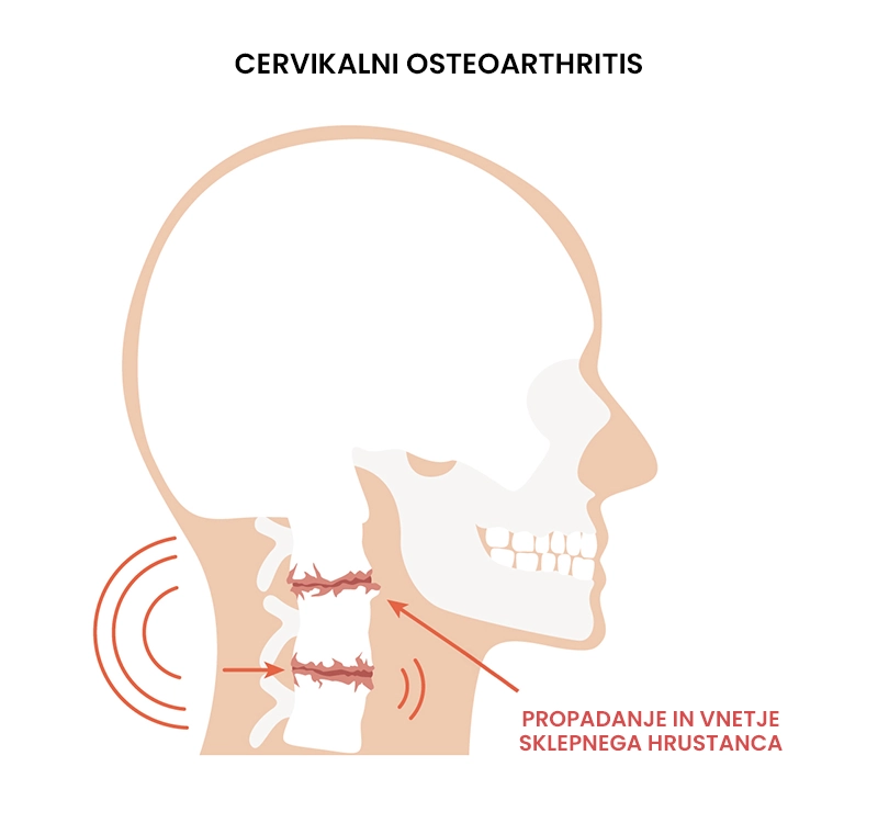 Cervikalni osteoartritis