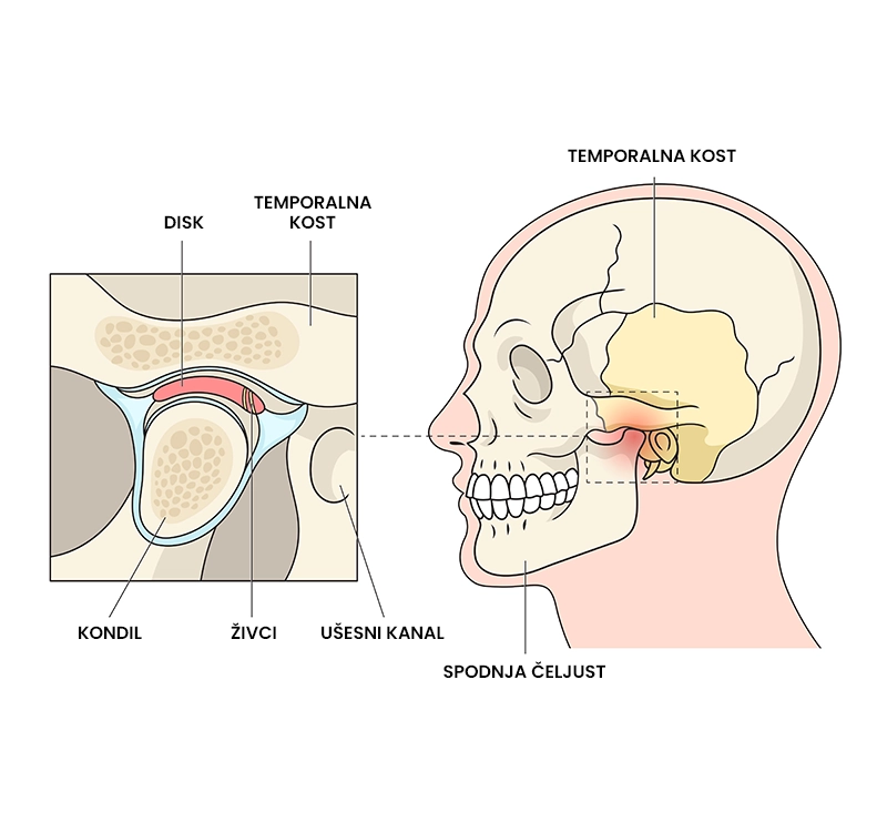 Disfunkcija temporomandibularnega (čeljustnega) sklepa