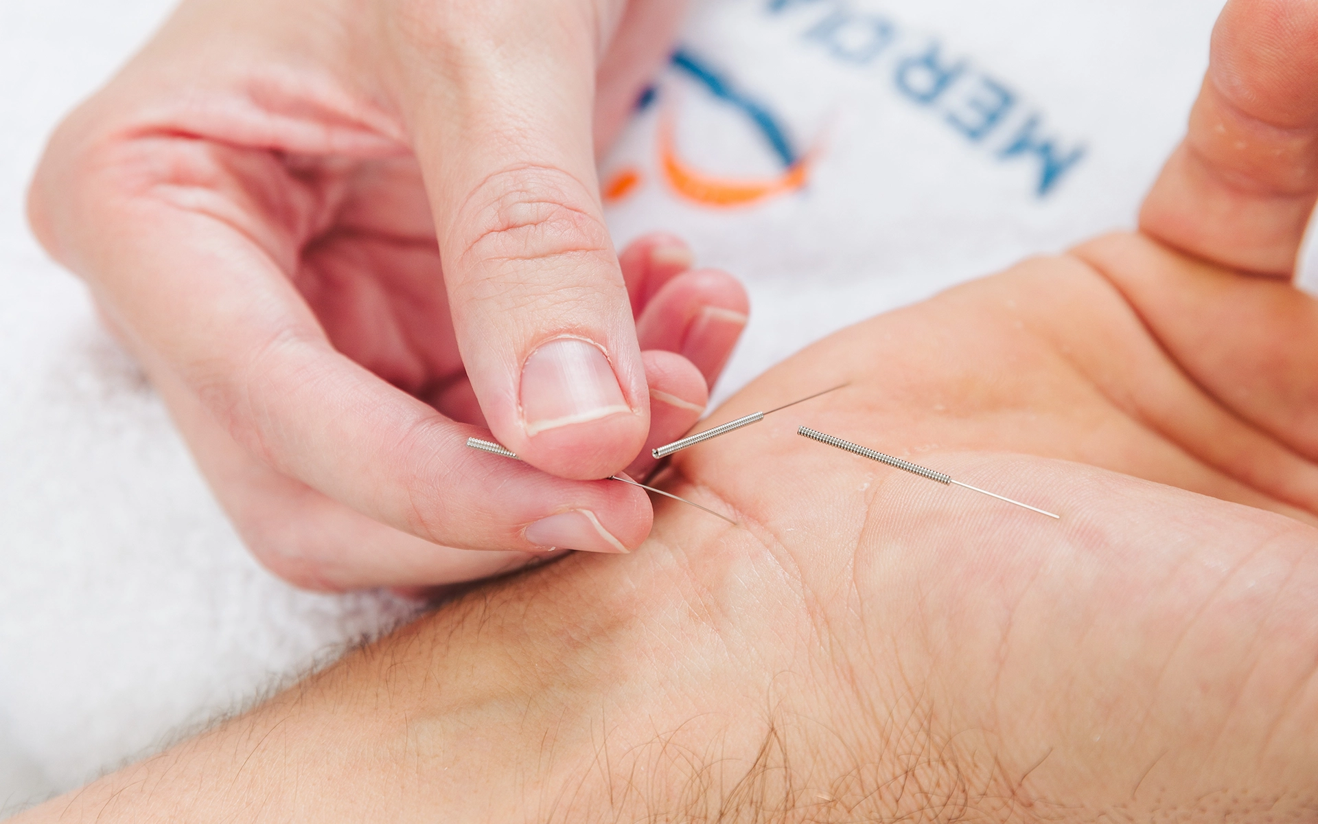 Dryneedling terapija