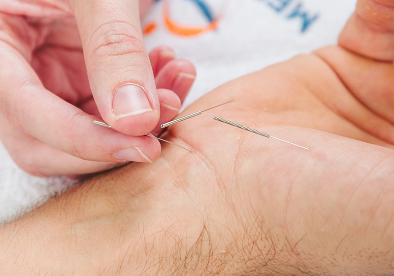 Dryneedling terapija