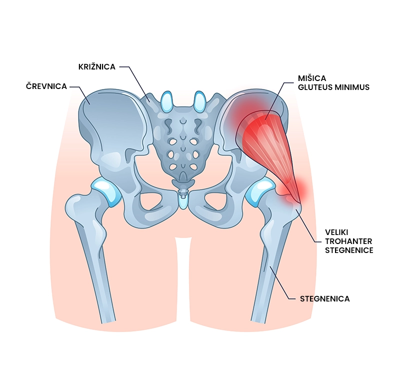 Glutealna tendinopatija