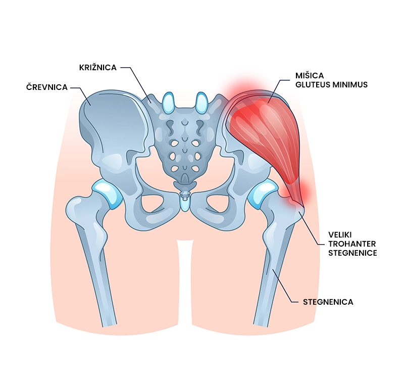 Glutealna tendinopatija