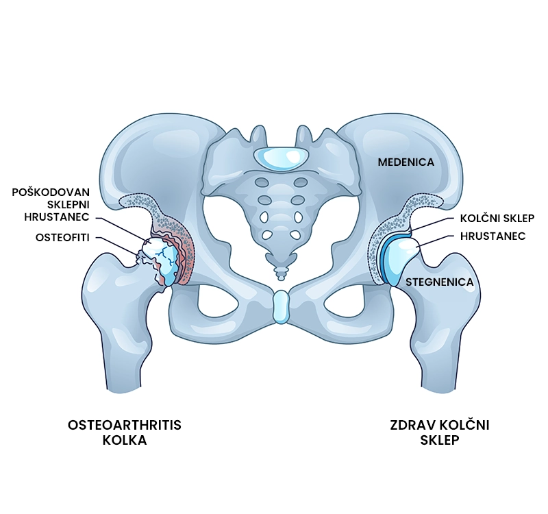 Osteoartritis kolka