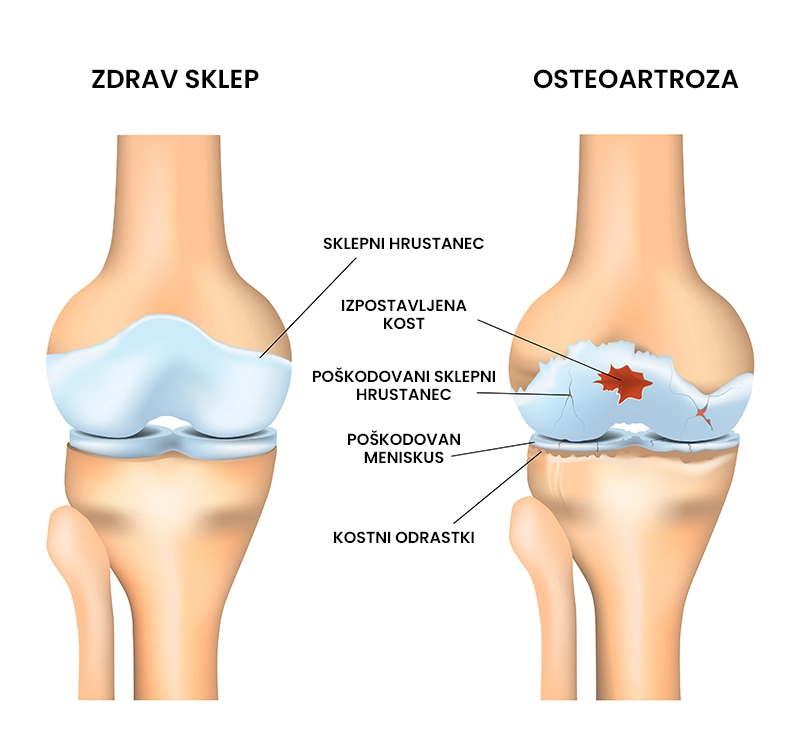 Osteoartroza (artroza)