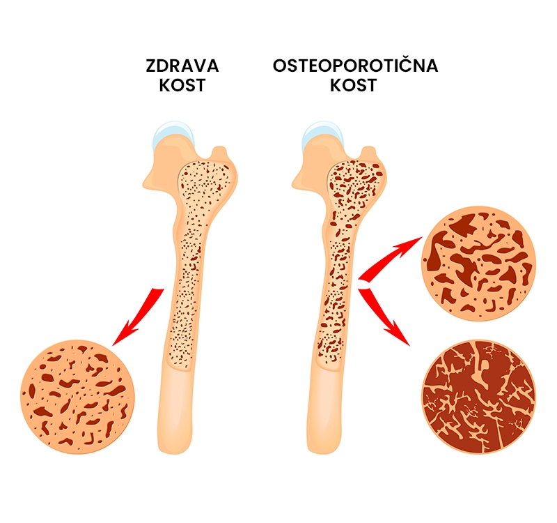 Osteoporoza