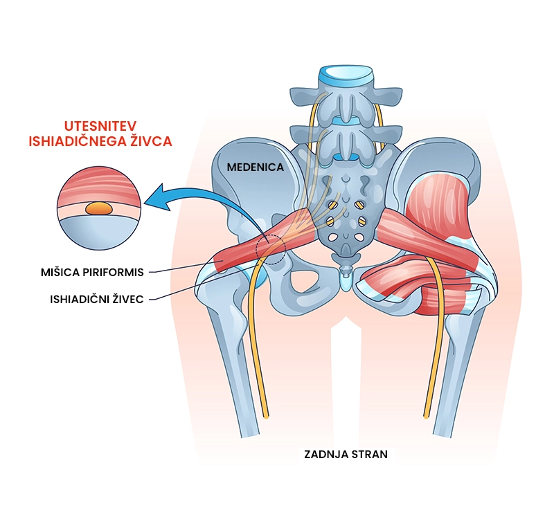 Piriformis sindrom kolka