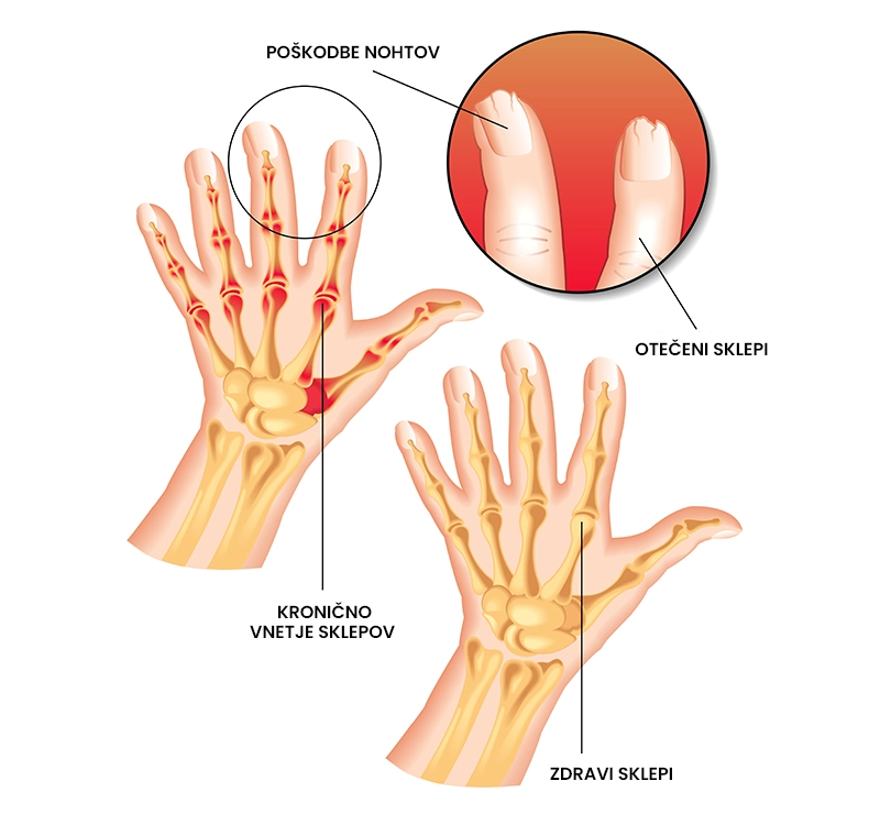 Psoriatični artritis