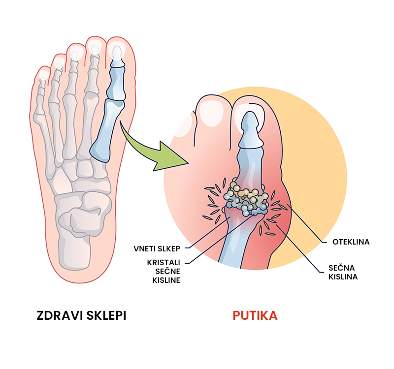 Putika (urični artritis, protin)