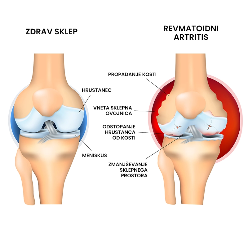 Revmatoidni artritis