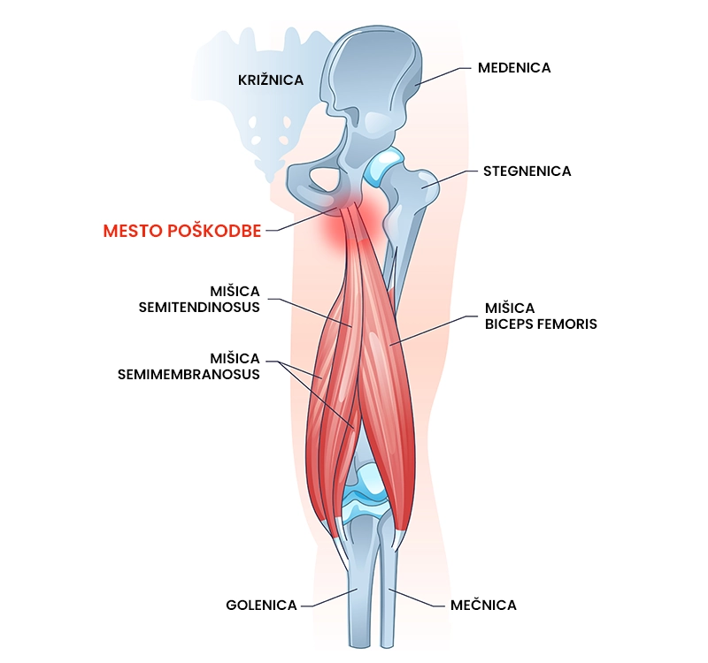 Tendinopatija zadnjih stegenskih mišic na izvoru