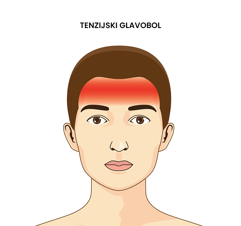 Tenzijski glavobol