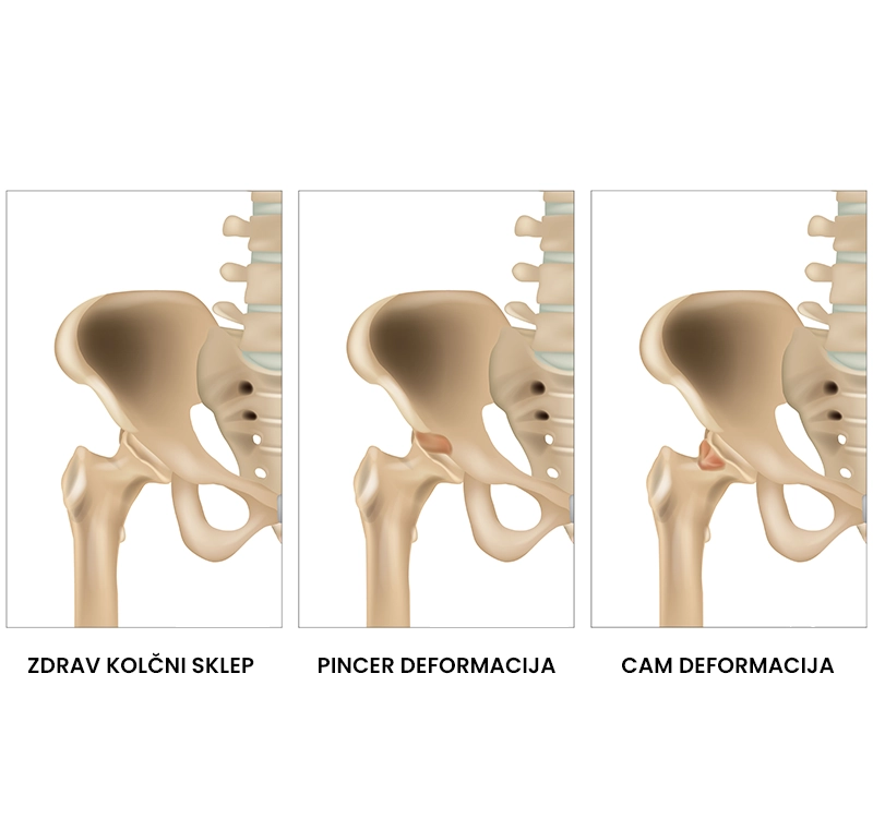 Utesnitveni sindrom kolka (femuroacetabularna utesnitev – FAI)