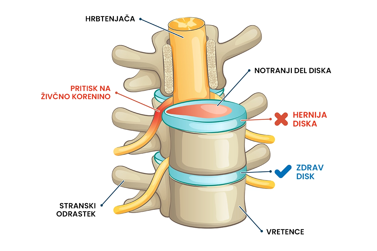 kaj je hernija