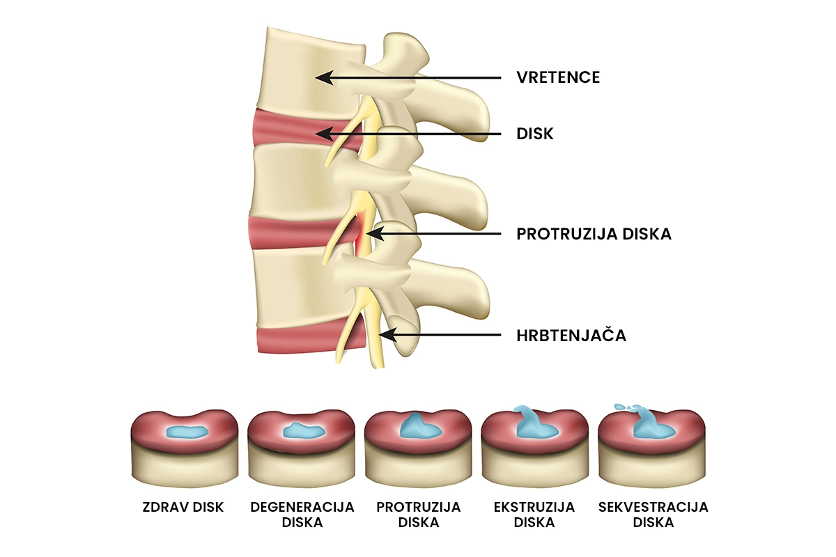 Vrste hernije