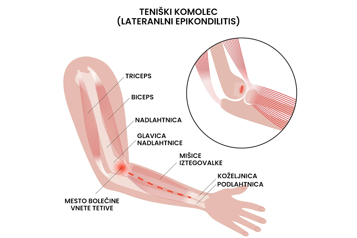 Teniški komolec