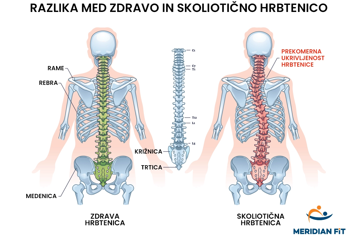 razlika med zdravo in skolioticno hrbtenico