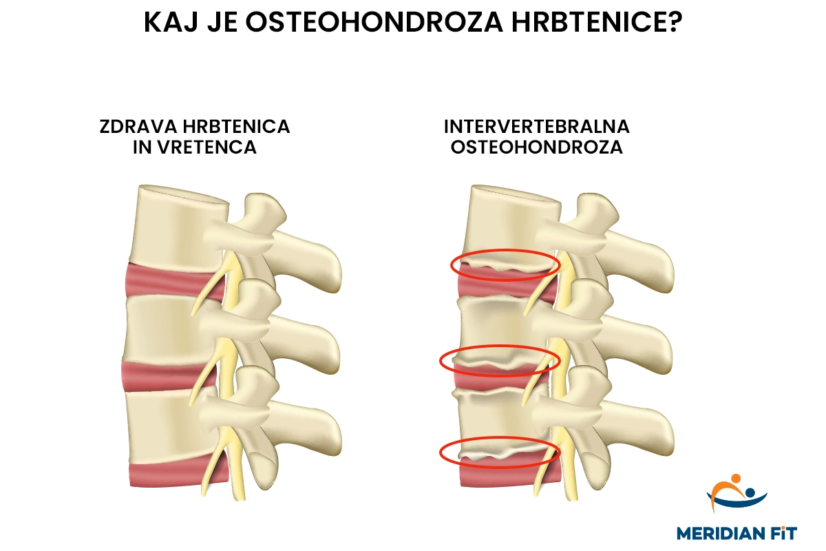 osteohondroza-hrbtenice