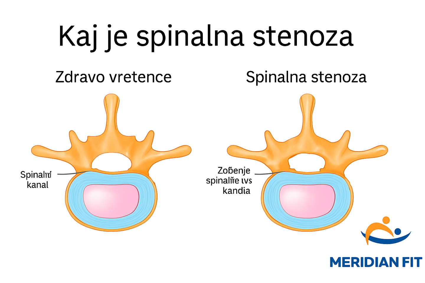 kaj-je-spinalna-stenoza